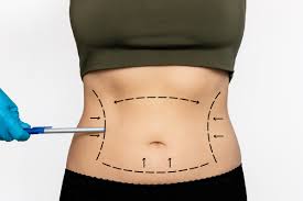Meet the Best Vaser Liposuction Surgeon in Dubai for Precision Body Sculpting