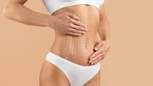 Liposuction in Dubai